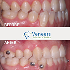 Custom-crafted premium porcelain veneers for tooth shape, color, and symmetry