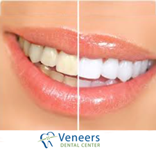 Clinical teeth whitening procedure removing deep tooth enamel stains