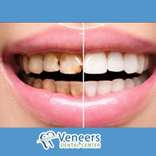 Tooth-colored composite fillings and restorations repairing decayed teeth