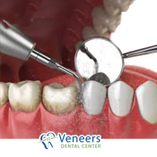 Ultrasonic dental scaling and polishing removing plaque and calculus