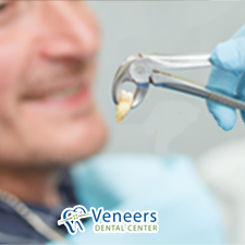 Safe surgical tooth extraction removing unsalvageable teeth gently