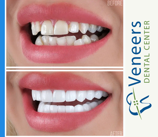 Before and after porcelain veneer smile makeover result