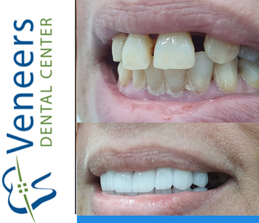 Smile makeover case study 2 - Natural Hollywood Smile alignment and brightening