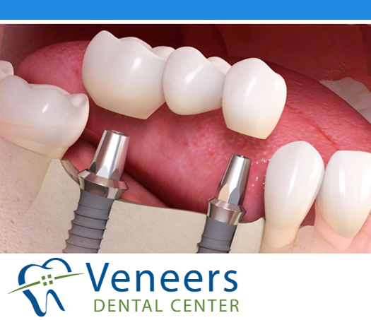 Smile makeover case study 3 - Dental implant and zirconia crown restoration