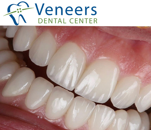 Smile makeover case study 4 - Orthodontic alignment and composite restoration