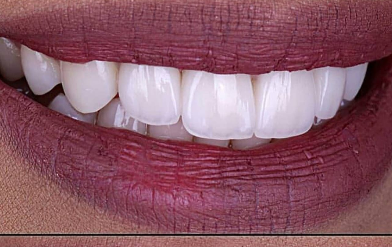 Hollywood Smile cosmetic makeover with custom-crafted porcelain veneers