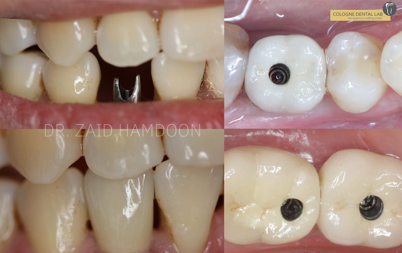 Titanium dental implant placement restoring missing tooth roots and jawbone health