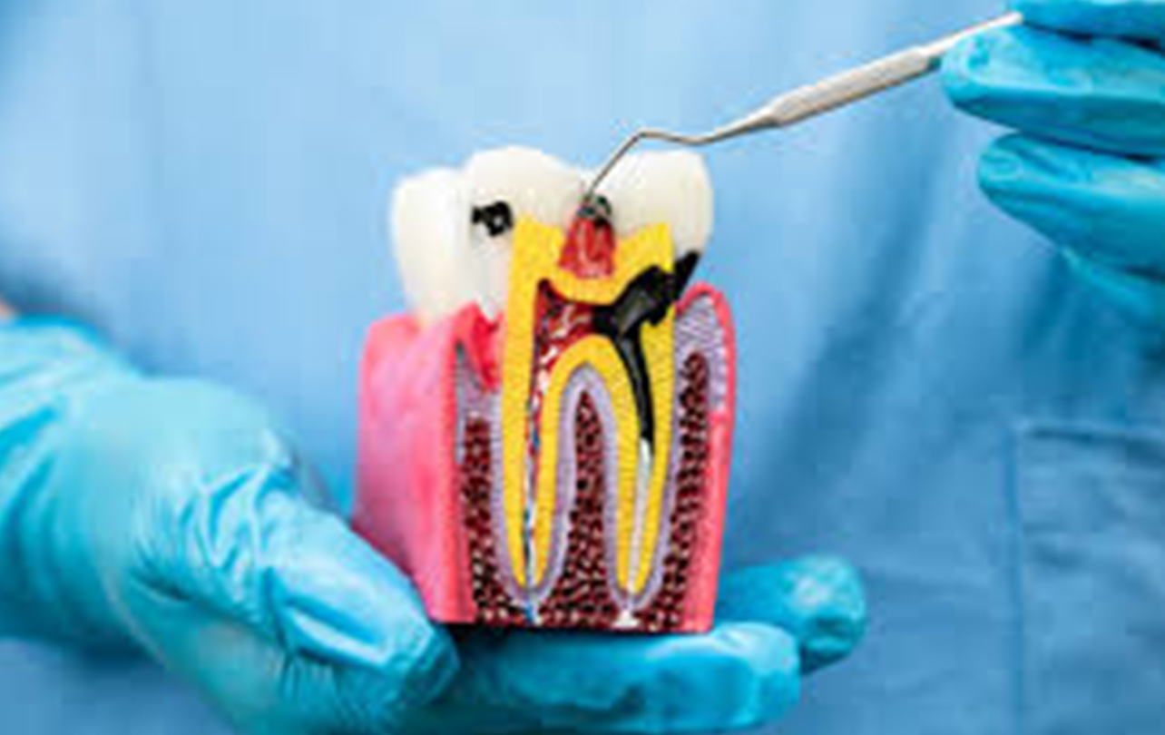 Gentle endodontic root canal therapy relieving acute tooth infection